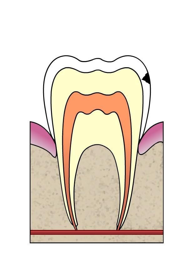 imagem evoluA§A£o da cA¡rie dental 2