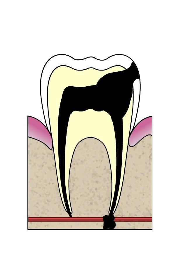 imagem evoluA§A£o da cA¡rie dental 5