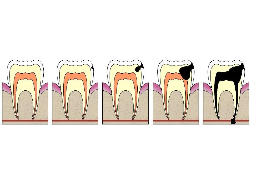 imagem evoluA§A£o da cA¡rie dental